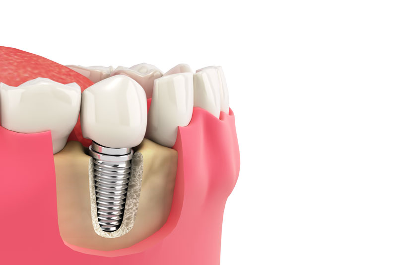 a single dental implant with cut aways of the gums and bone that show the implants placement in the jaw