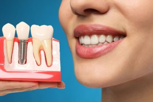 A woman smiles, holding a dental implant model showing the post and crown, emphasizing the natural, restored look and aesthetic benefits.