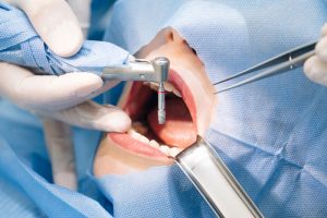 a dental implant patient with an implant about to be placed into the jaw
