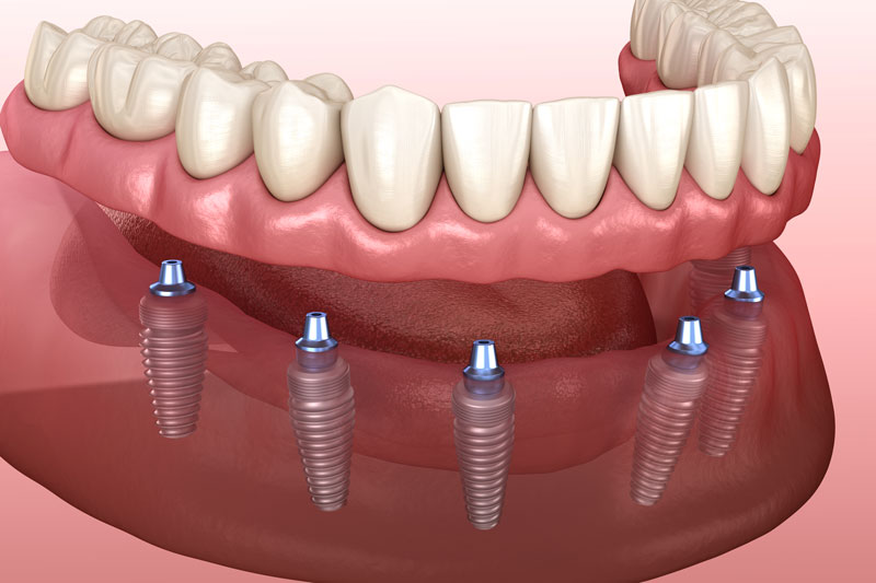a full arch of teeth with 6 implants placed into the jaw to hold the arch