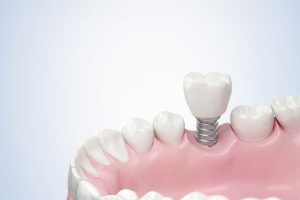 A close-up of a dental implant model showing a white tooth and pink gums illustrates the integration of a dental implant into the jaw for medical education.