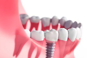 Close-up of a dental implant integrated into the lower jaw, illustrating the implant's placement and its realistic appearance alongside natural teeth.
