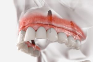 a full arch of teeth with 4 implants placed into the mouth