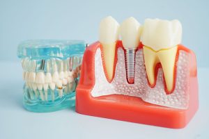 a cut away of the teeth with an implant being shown and a full arch of teeth near it