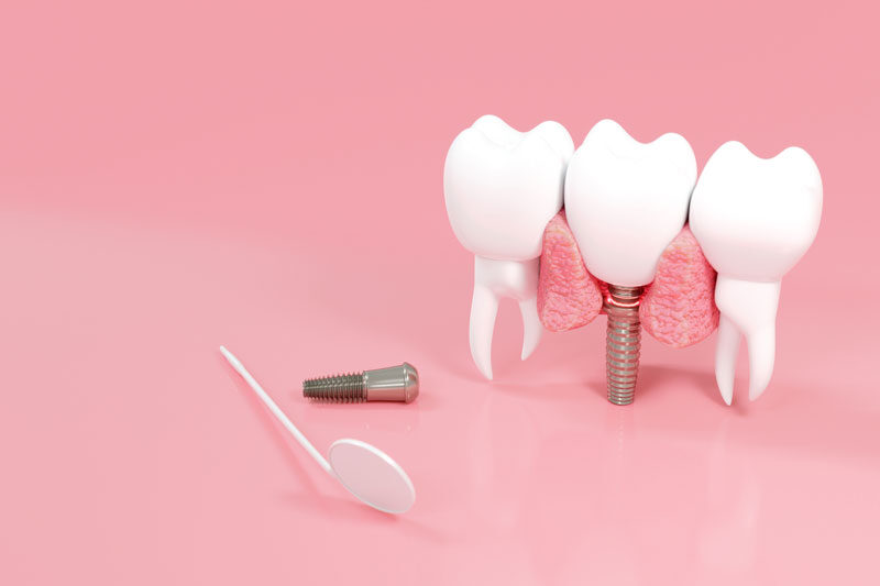 an implant with a mirror facing towards it and surrounded by 2 teeth
