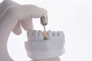 a single dental implant with a tool to place it being shown