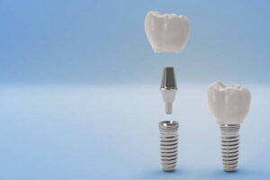 Dental Implant