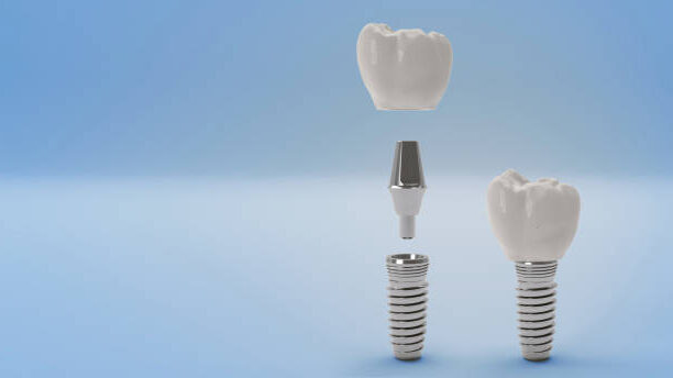 Dental Implant