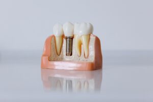 Are Dental Implants Safe
